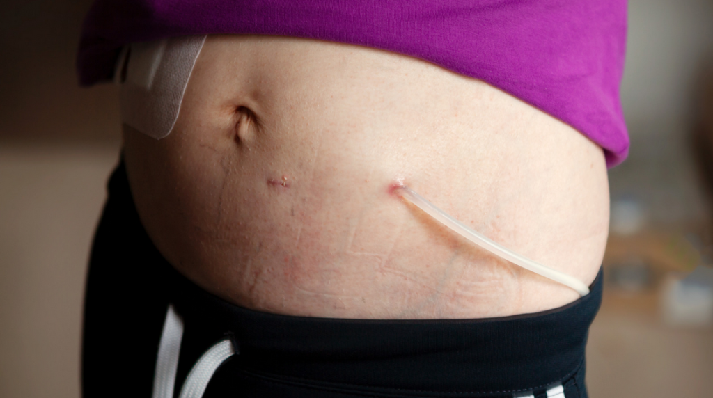 suprapubic catheters